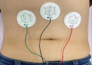 Abdominal electrodes to record bowel contractions for the EndoSure endometriosis diagnosis test